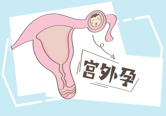 試管后如何避免宮外孕(試管嬰兒能避免宮外孕嗎) 試管后如何避免宮外孕(試管嬰兒能避免宮外孕嗎)