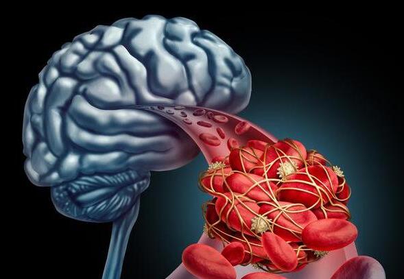 腦中風后一般能活多久 腦中風后一般能活多久