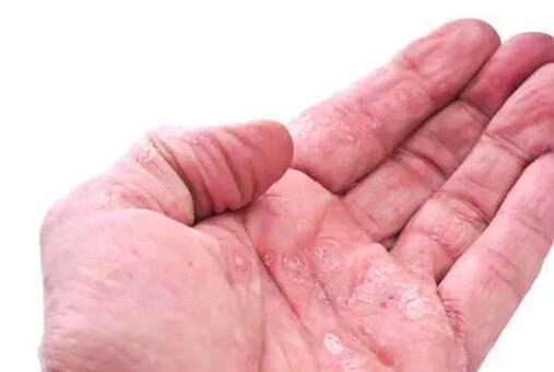 手部濕疹是什么原因引起的 手部濕疹是什么原因引起的