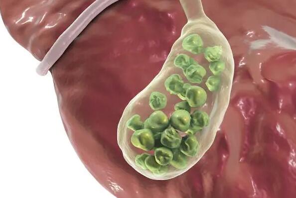 得了膽結石不能吃什么食物 膽結石飲食需要注意什么