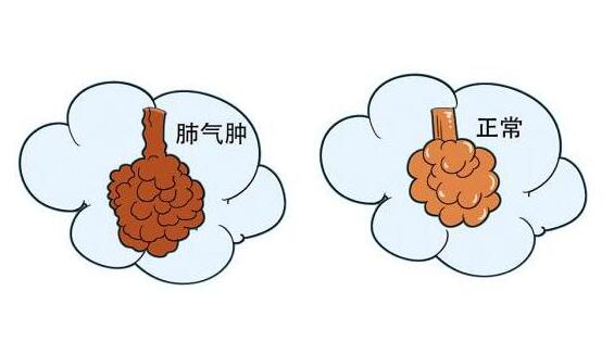 什么是肺氣腫?肺氣腫嚴重嗎?