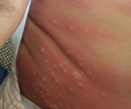 毛毛蟲皮炎如何治療