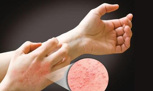 接觸性皮炎是什么原因引起的