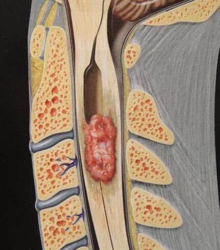 脊髓腫瘤能活多久
