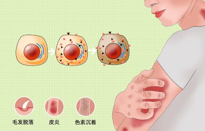 如何治療放射性皮炎