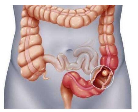 直腸癌早期癥狀