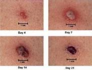 流行性斑疹傷寒