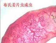 姜片蟲病