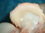 膝關節半月板損傷