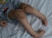 先天性骨與關(guān)節(jié)畸形