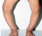 先天性膝關節畸形