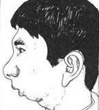 顳下頜關節強直