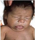 小兒甲狀腺功能減低癥