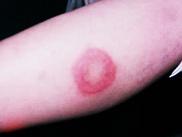 小兒風(fēng)濕熱