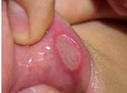 小兒潰瘍性口炎