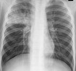 小兒支氣管肺炎