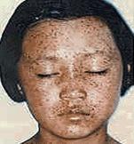 小兒豹皮綜合征