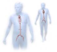 腹主動(dòng)脈縮窄