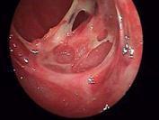 急性出血性壞死性腸炎
