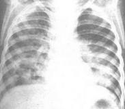 老年人支原體肺炎