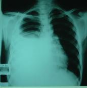 類肺炎性胸腔積液