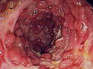 淀粉樣變病的胃腸道表現(xiàn)