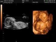 胎兒宮內(nèi)窘迫