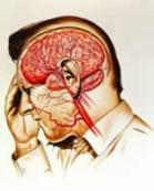 短暫性腦缺血發(fā)作