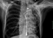 食管外壓和牽拉