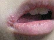 單純皰疹性腦炎