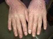 銀屑病性關節炎