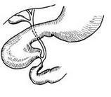 十二指腸血管性壓迫綜合征