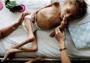 蛋白質-能量營養不良