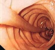 小兒膽道蛔蟲癥