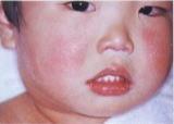小兒潮紅綜合征
