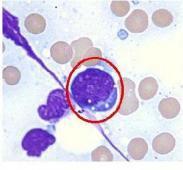 小兒伯-韋綜合征