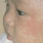 先天性風疹綜合征