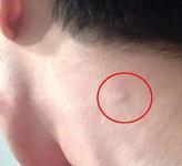 頸部淋巴結轉移癌