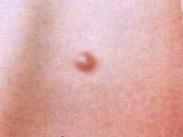 靶樣含鐵血黃素沉積性血管瘤