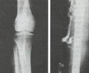 先天性靜脈畸形肢體肥大綜合征