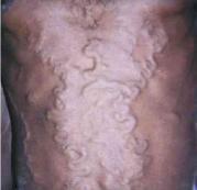 靜脈曲張綜合征