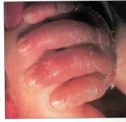 小兒金葡菌性燙傷樣皮膚綜合征