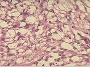 小腸平滑肌肉瘤