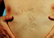 皮膚豬囊尾蚴病