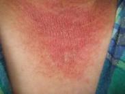 麻疹樣紅斑型藥疹