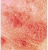 新生兒?jiǎn)渭儼捳畈《靖腥? title=