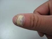 全身性念珠菌病