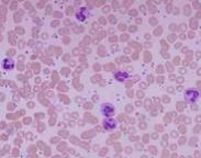 小兒先天性白細胞顆粒異常綜合征