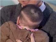 小兒維生素D缺乏性佝僂病