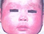 小兒滲出性多形性紅斑